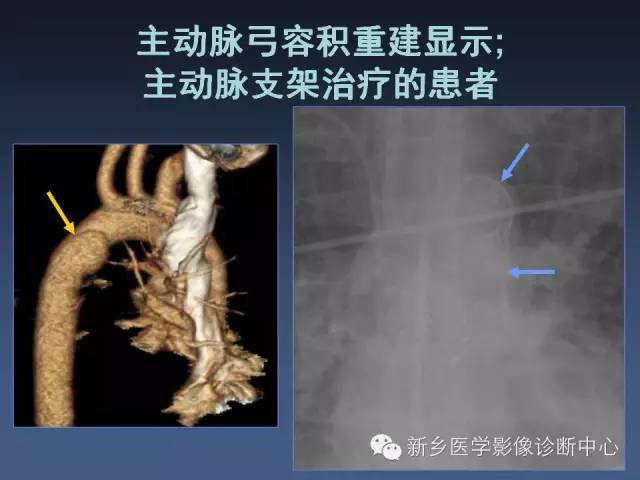 【PPT】多层螺旋CT（MDCT）在胸部外伤诊断中的应用