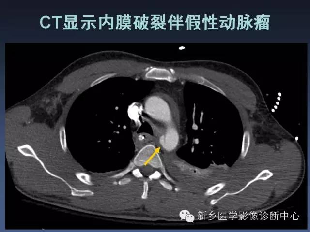 【PPT】多层螺旋CT（MDCT）在胸部外伤诊断中的应用