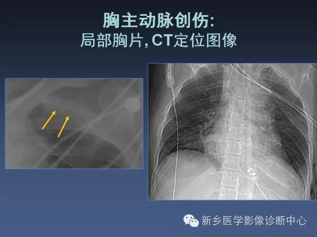 【PPT】多层螺旋CT（MDCT）在胸部外伤诊断中的应用