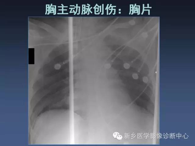 【PPT】多层螺旋CT（MDCT）在胸部外伤诊断中的应用
