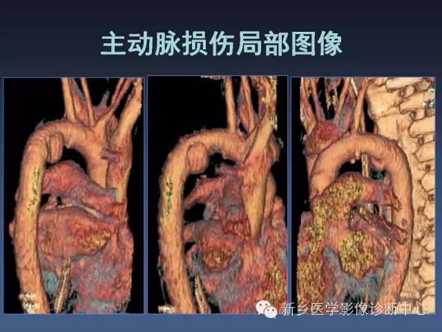 【PPT】多层螺旋CT（MDCT）在胸部外伤诊断中的应用