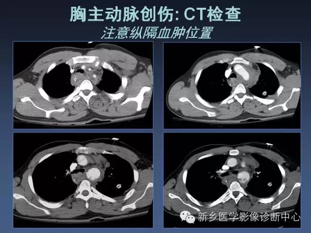 【PPT】多层螺旋CT（MDCT）在胸部外伤诊断中的应用
