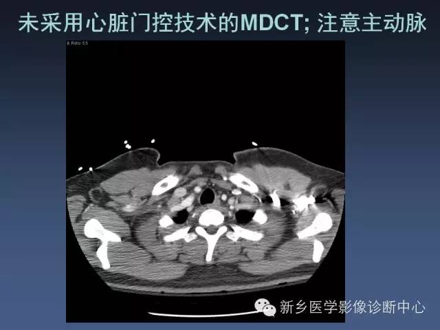 【PPT】多层螺旋CT（MDCT）在胸部外伤诊断中的应用