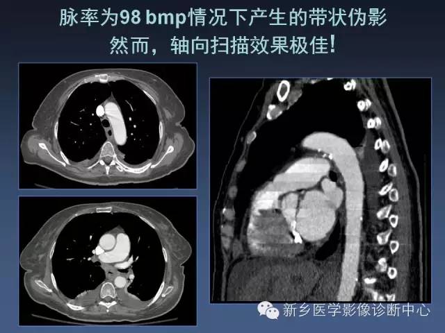 【PPT】多层螺旋CT（MDCT）在胸部外伤诊断中的应用