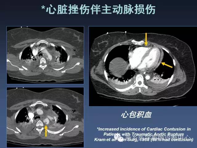 【PPT】多层螺旋CT（MDCT）在胸部外伤诊断中的应用