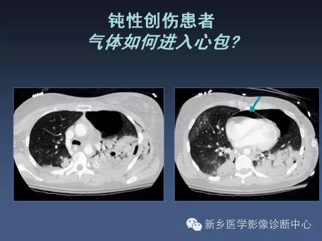 【PPT】多层螺旋CT（MDCT）在胸部外伤诊断中的应用