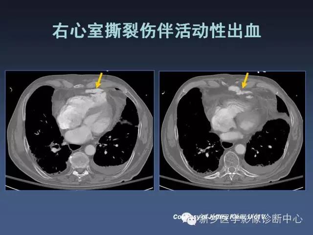 【PPT】多层螺旋CT（MDCT）在胸部外伤诊断中的应用