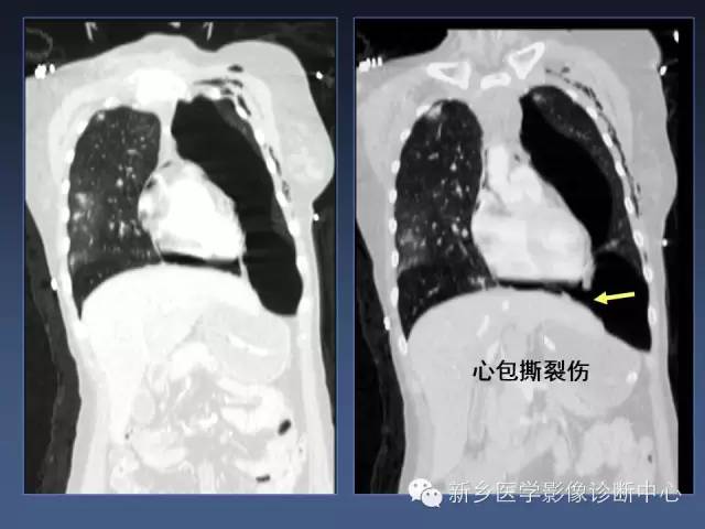 【PPT】多层螺旋CT（MDCT）在胸部外伤诊断中的应用