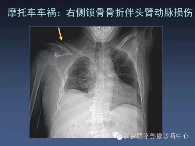 【PPT】多层螺旋CT（MDCT）在胸部外伤诊断中的应用
