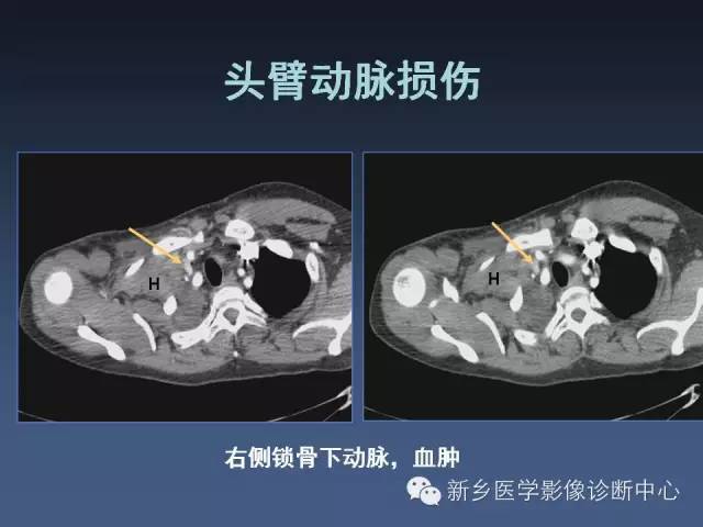 【PPT】多层螺旋CT（MDCT）在胸部外伤诊断中的应用