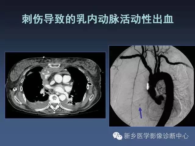 【PPT】多层螺旋CT（MDCT）在胸部外伤诊断中的应用
