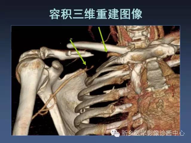 【PPT】多层螺旋CT（MDCT）在胸部外伤诊断中的应用