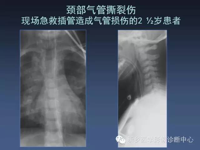 【PPT】多层螺旋CT（MDCT）在胸部外伤诊断中的应用