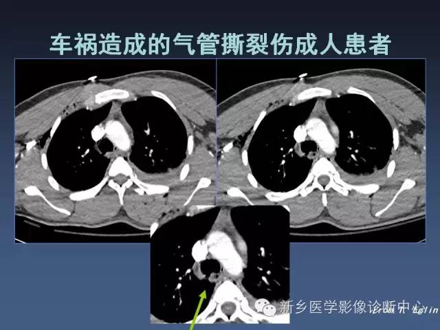 【PPT】多层螺旋CT（MDCT）在胸部外伤诊断中的应用