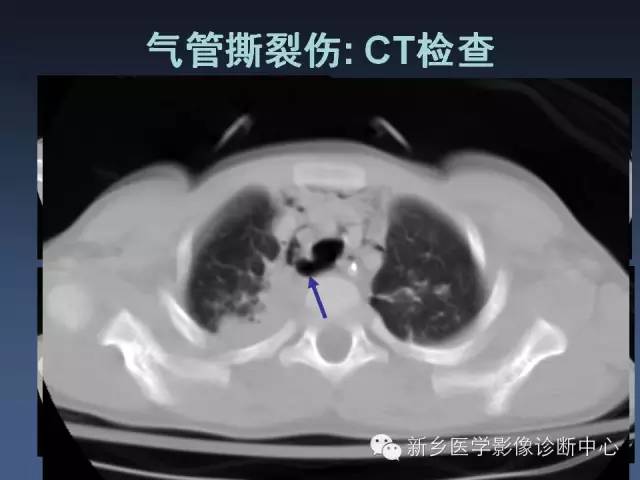 【PPT】多层螺旋CT（MDCT）在胸部外伤诊断中的应用