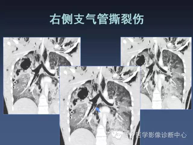 【PPT】多层螺旋CT（MDCT）在胸部外伤诊断中的应用