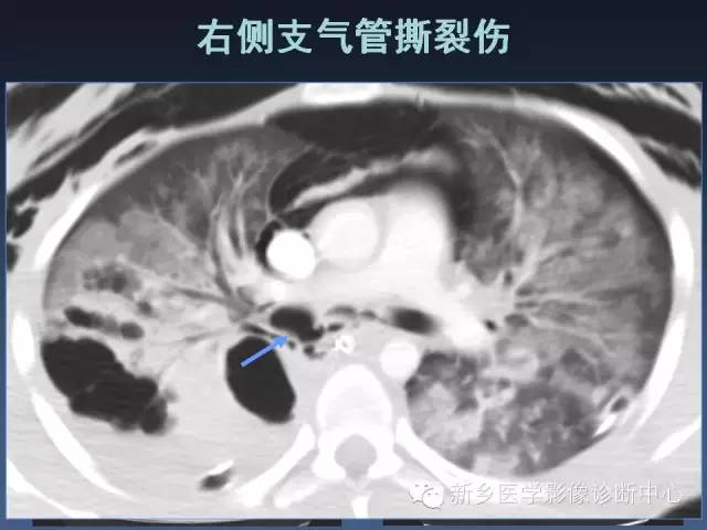 【PPT】多层螺旋CT（MDCT）在胸部外伤诊断中的应用