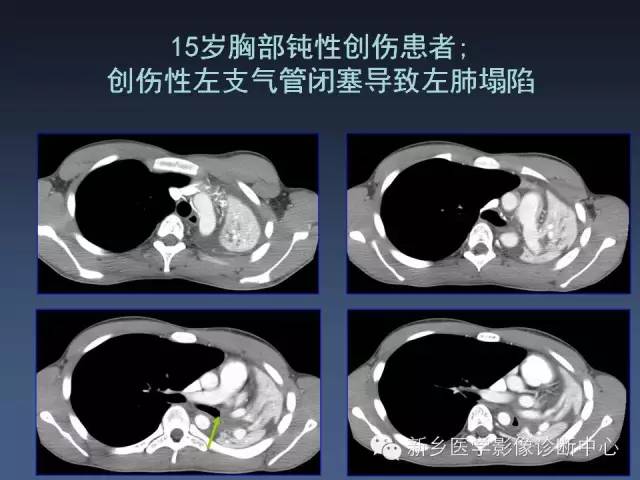 【PPT】多层螺旋CT（MDCT）在胸部外伤诊断中的应用