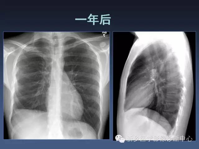 【PPT】多层螺旋CT（MDCT）在胸部外伤诊断中的应用