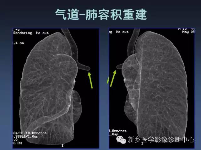【PPT】多层螺旋CT（MDCT）在胸部外伤诊断中的应用