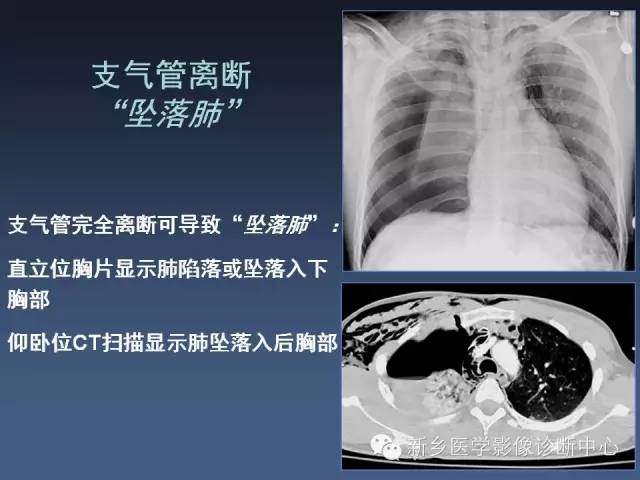 【PPT】多层螺旋CT（MDCT）在胸部外伤诊断中的应用