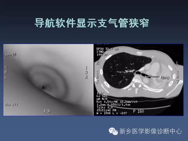 【PPT】多层螺旋CT（MDCT）在胸部外伤诊断中的应用