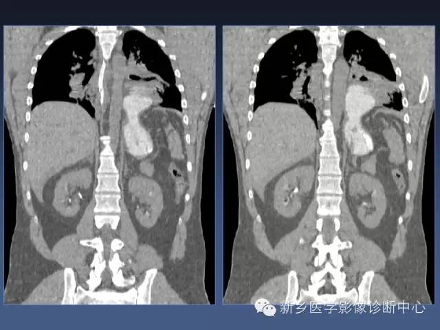 【PPT】多层螺旋CT（MDCT）在胸部外伤诊断中的应用