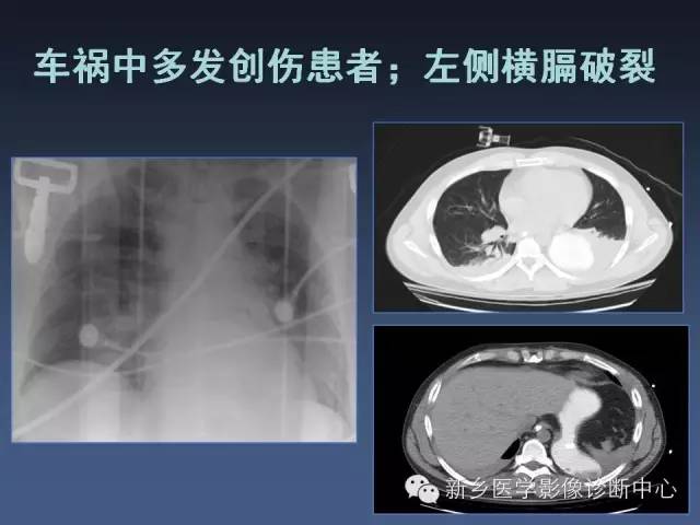 【PPT】多层螺旋CT（MDCT）在胸部外伤诊断中的应用