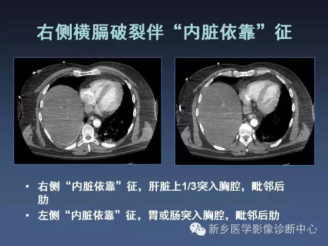 【PPT】多层螺旋CT（MDCT）在胸部外伤诊断中的应用