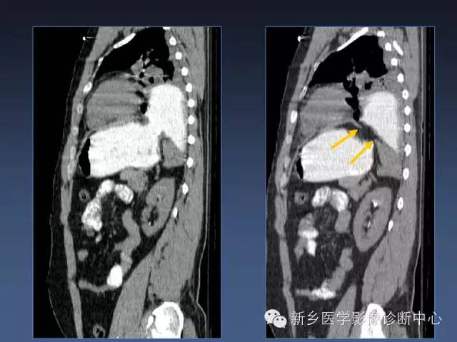 【PPT】多层螺旋CT（MDCT）在胸部外伤诊断中的应用