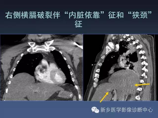 【PPT】多层螺旋CT（MDCT）在胸部外伤诊断中的应用