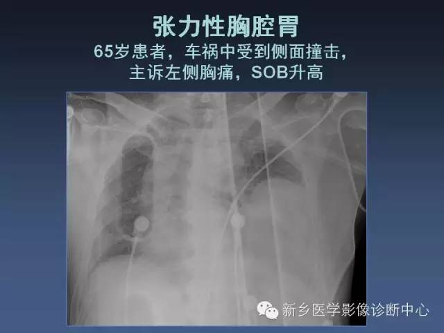 【PPT】多层螺旋CT（MDCT）在胸部外伤诊断中的应用