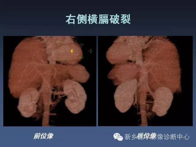 【PPT】多层螺旋CT（MDCT）在胸部外伤诊断中的应用