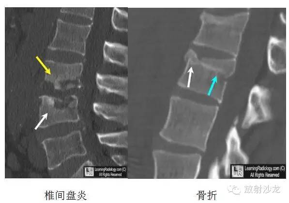 【病例】椎缘骨1例X线及CT影像表现 【病例】椎缘骨1例X线及CT影像表现