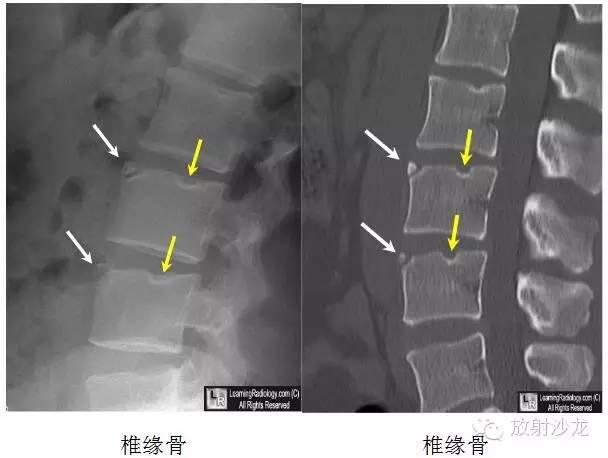 【病例】椎缘骨1例X线及CT影像表现 【病例】椎缘骨1例X线及CT影像表现
