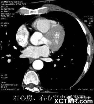 心脏CT横断面解剖 心脏CT横断面解剖