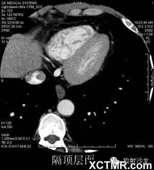 心脏CT横断面解剖 心脏CT横断面解剖