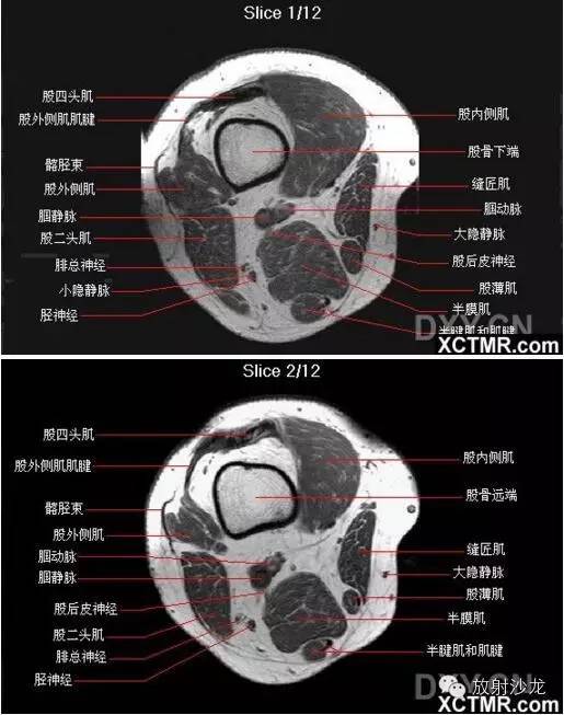 正常膝关节轴位MRI 解剖