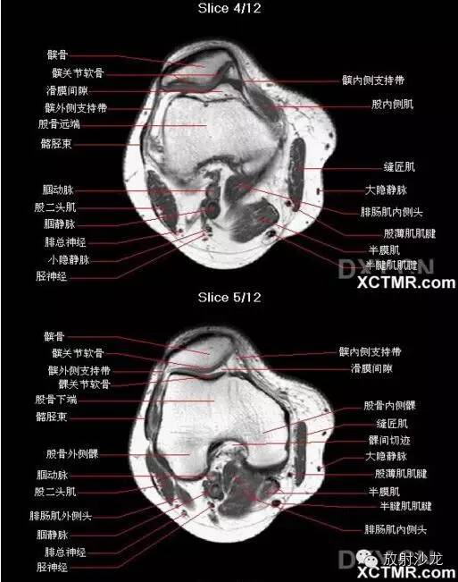 正常膝关节轴位MRI 解剖