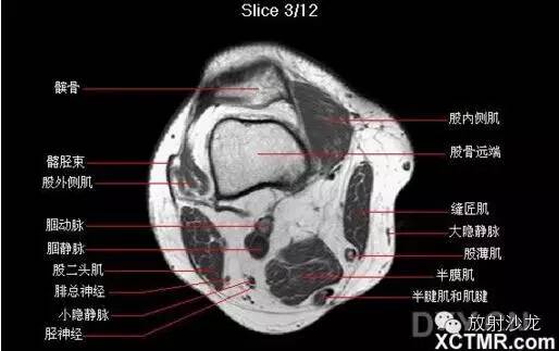 正常膝关节轴位MRI 解剖