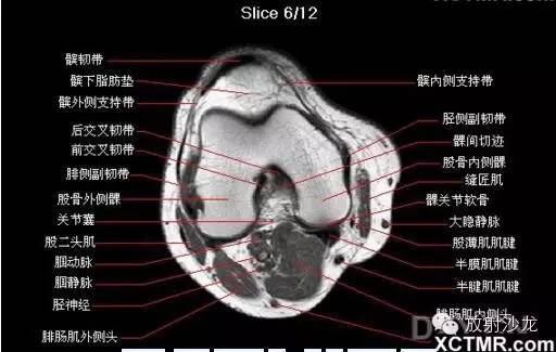 正常膝关节轴位MRI 解剖