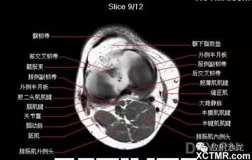 正常膝关节轴位MRI 解剖