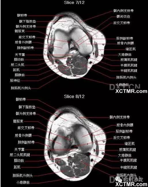 正常膝关节轴位MRI 解剖