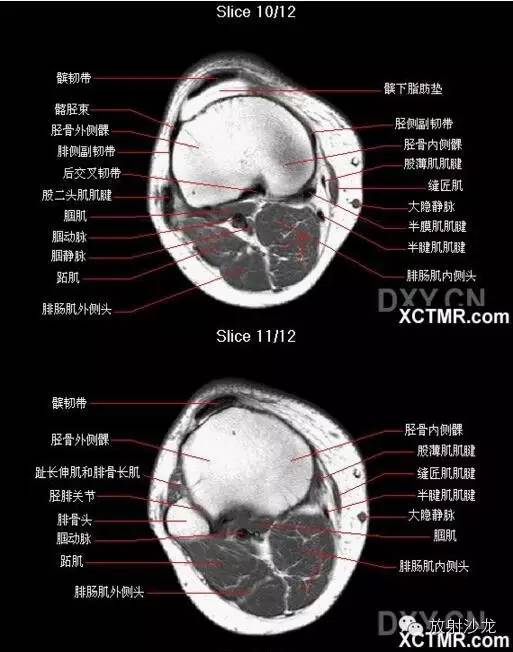 正常膝关节轴位MRI 解剖