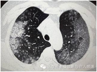 【病例】弥漫性肺腺癌1例CT影像表现 【病例】弥漫性肺腺癌1例CT影像表现