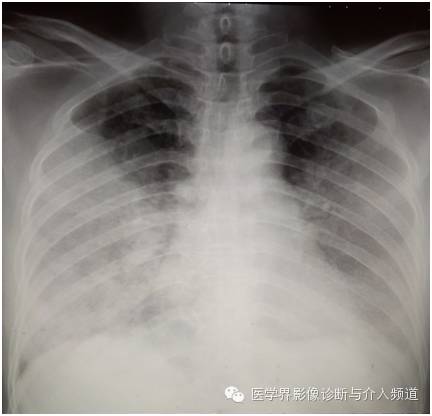 【病例】弥漫性肺腺癌1例CT影像表现