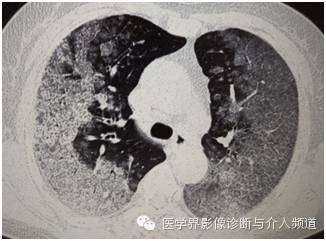 【病例】弥漫性肺腺癌1例CT影像表现 【病例】弥漫性肺腺癌1例CT影像表现