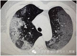 【病例】弥漫性肺腺癌1例CT影像表现 【病例】弥漫性肺腺癌1例CT影像表现