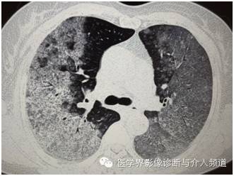 【病例】弥漫性肺腺癌1例CT影像表现 【病例】弥漫性肺腺癌1例CT影像表现