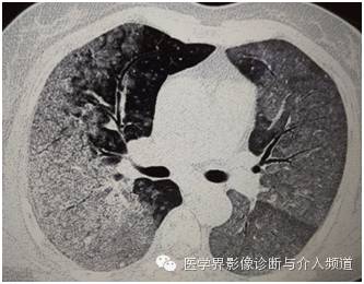 【病例】弥漫性肺腺癌1例CT影像表现 【病例】弥漫性肺腺癌1例CT影像表现